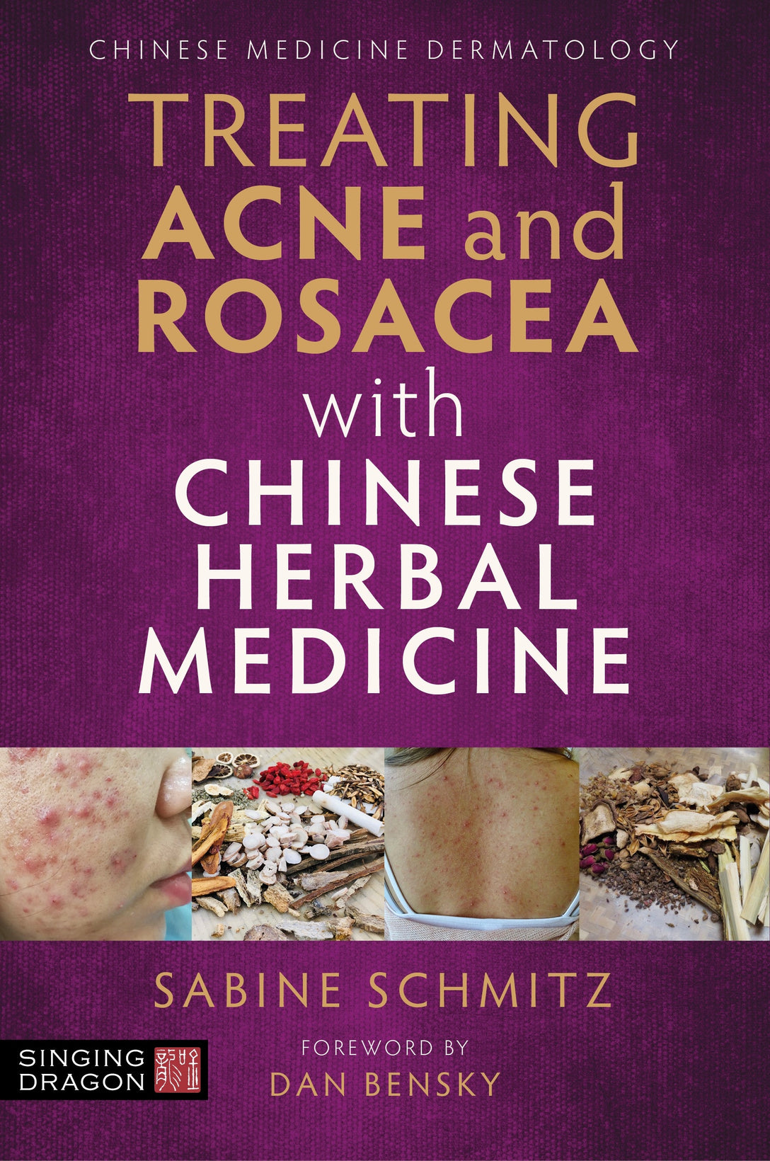 Treating Acne and Rosacea with Chinese Herbal Medicine by Sabine Schmitz, Dan Bensky